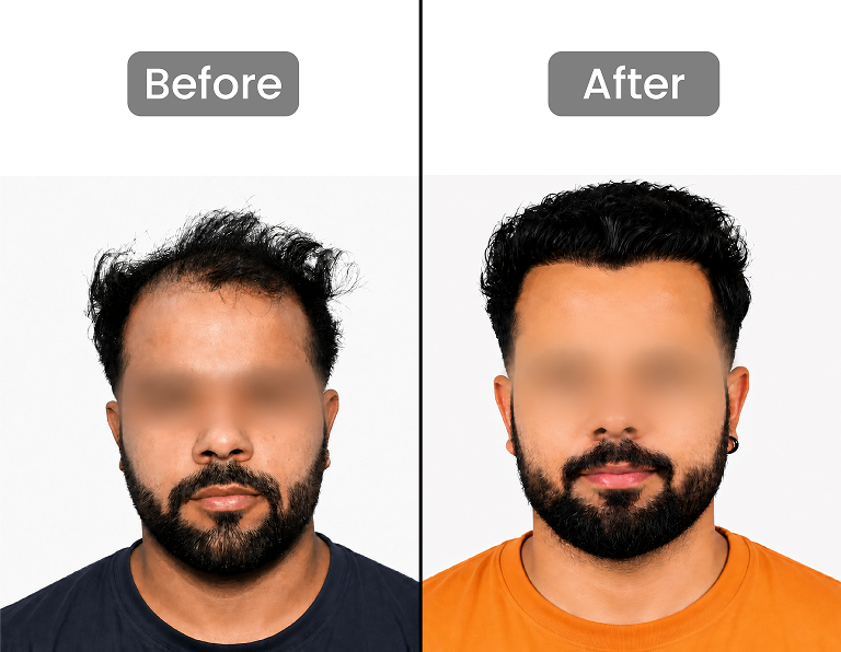 Hair Restoration Result 3