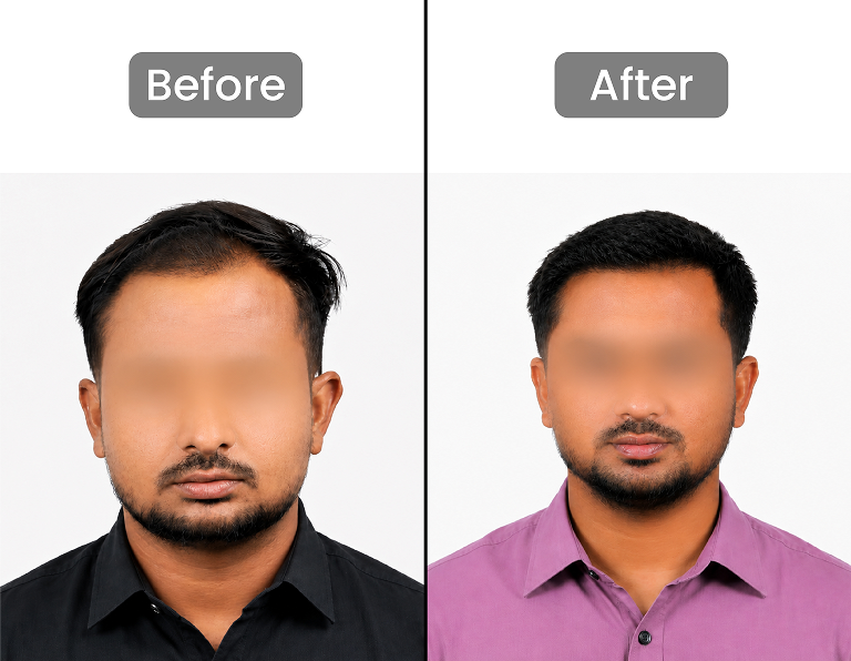 Hair Restoration Result 5