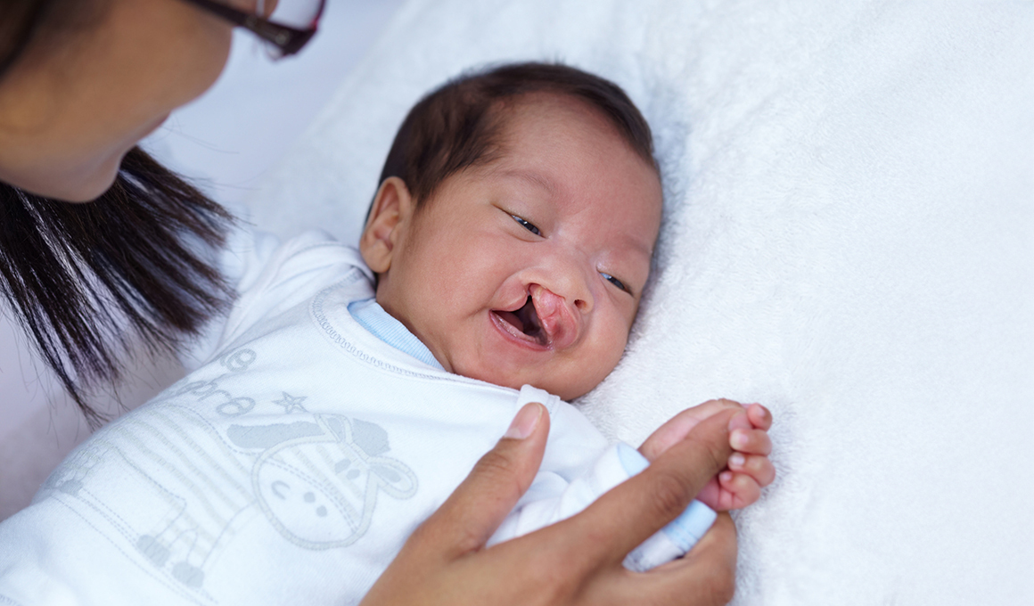 Cleft-Lip-&-Palate-Repair
