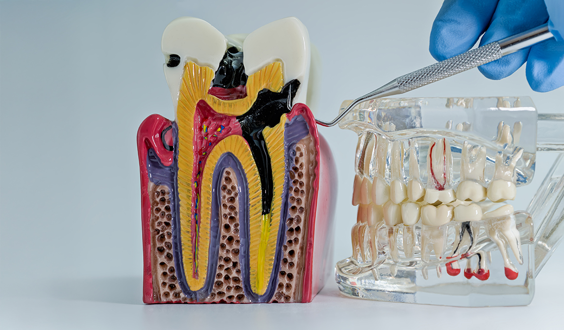 Root-Canal-Treatment-(RCT)