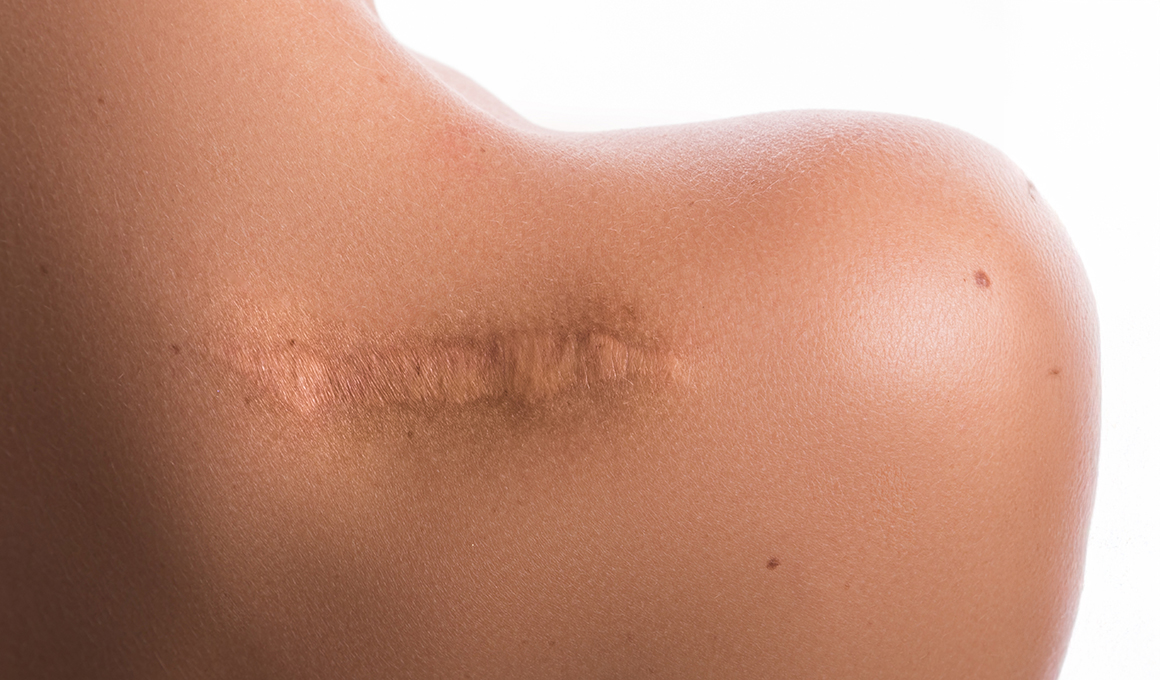 Scar-Revision-Surgery