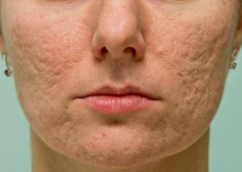 Acne Scars Treatment in mumbai india