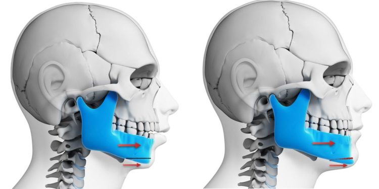 Orthognathic Jaw Surgery in mumbai, india