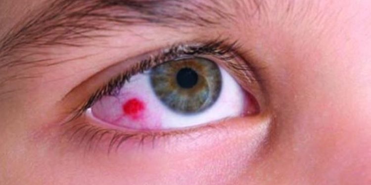 Common Eye Tumor in Children – Retinoblastoma in mumbai india