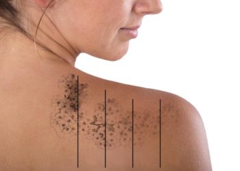 Things You Should Know About Tattoo Removal in mumbai india