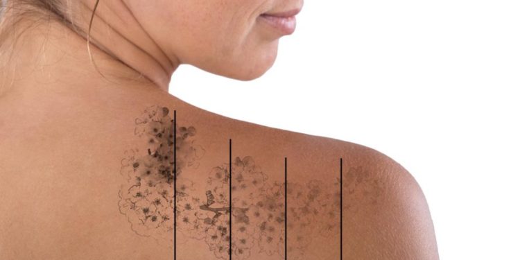 Things You Should Know About Tattoo Removal in mumbai india