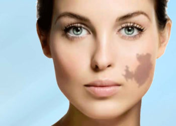 Know more about Birthmark Removal Surgery in mumbai india
