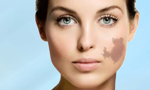 Know more about Birthmark Removal Surgery in mumbai india