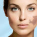 Know more about Birthmark Removal Surgery in mumbai india
