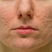 Acne Scar Laser Treatment-The Best Solution For Your Acne Scarring