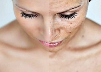 Rejuvenate Your Skin-Get Cosmetic Skin Peel Treatment