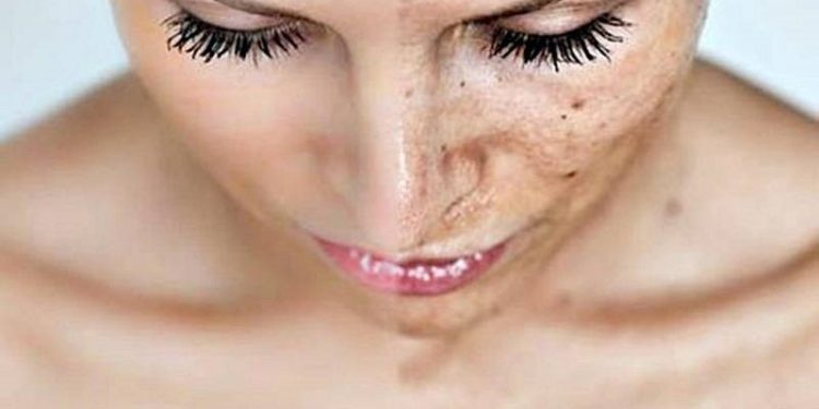 Rejuvenate Your Skin-Get Cosmetic Skin Peel Treatment
