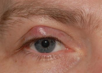 Conjunctival cyst removal Know what to do