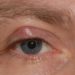 Conjunctival cyst removal Know what to do