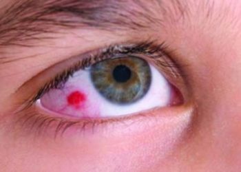 Types of Retinoblastoma treatments available