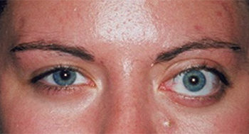 Orbital Tumor Explore the Treatment Options