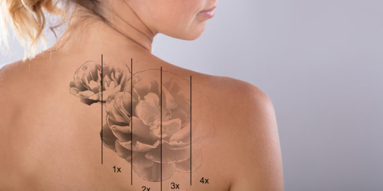 Get effective & easier tattoo removal treatment in India - visit The Esthetic Clinics