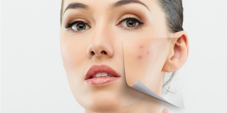 Say goodbye to annoying acne issues - Get acne scar treatment in mumbai India