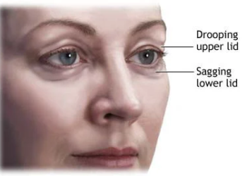 Benefits Of Blepharoplasty Surgery In Mumbai