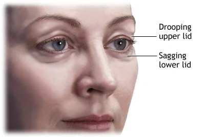 Benefits Of Blepharoplasty Surgery In Mumbai