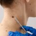 Different Methods And Considerations For Mole or Wart Removal