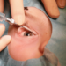 Lacrimal Surgery Explained