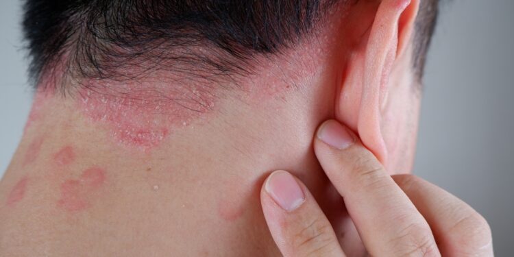 Psoriasis diagnosis and treatment in Mumbai