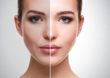 Skin Whitening Treatment, Procedures, Cost, And Side Effects