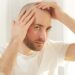 The Top 3 Essential Considerations Before Opting For a Hair Transplant