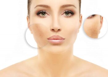 Types, Causes, And Treatment Options For Birthmark Removal