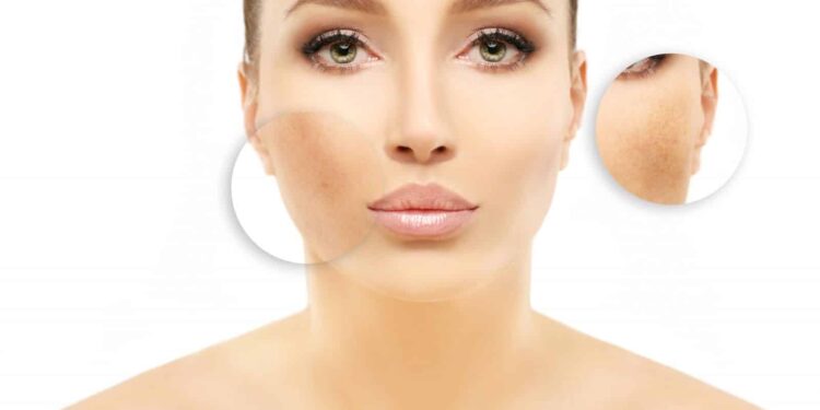 Types, Causes, And Treatment Options For Birthmark Removal