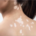 Understanding Vitiligo Causes And Treatment