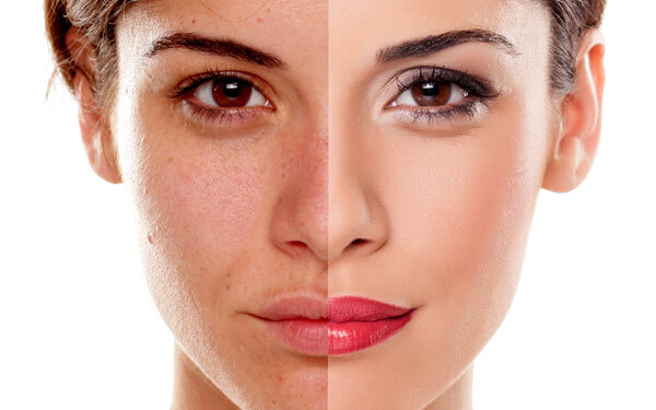 Can Pigmentation Come Back After Treatment?