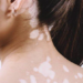 Can Vitiligo Completely Go Away?