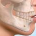 Choosing the Right Surgeon for Orthognathic Surgery