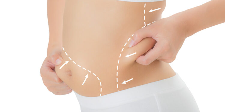 Is Liposuction Surgery Risky?