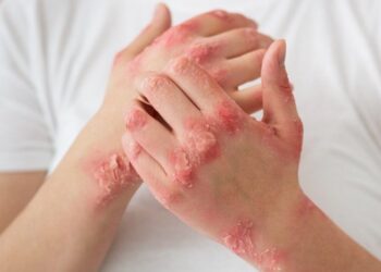 Psoriasis Triggers and How to Stop it From Spreading