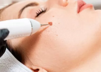 What are the Benefits of Removing a Birthmark?