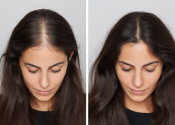 What is the Best Age for Hair Transplant