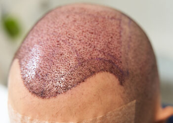 why how many grafts is the wrong first question to ask hair transplant surgeon