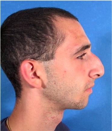 Chin-Augmentation