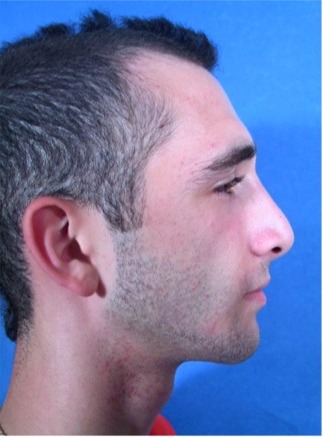 Chin-Implant