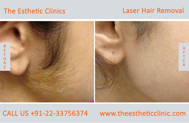 https://www.theestheticclinics.com/images/Skin%20Treatment/Laser%20Hair%20Removal/Permanent%20Laser%20Hair%20Removal%20Treatment%20before%20after%20photos%20in%20mumbai%20india%20%282%29.jpg