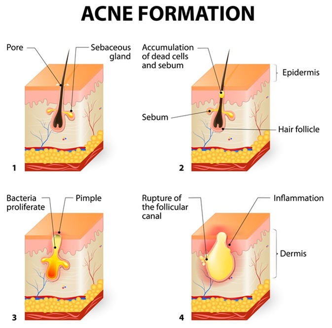 Best Acne Treatment in Mumbai at Affordable Price Cost India by Dr Rinky Kapoor at The Esthetic Clinics