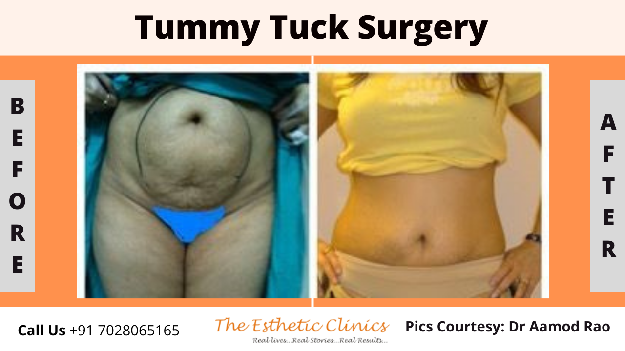 Best Body Contouring Surgery Treatment before after photos in Mumbai, India