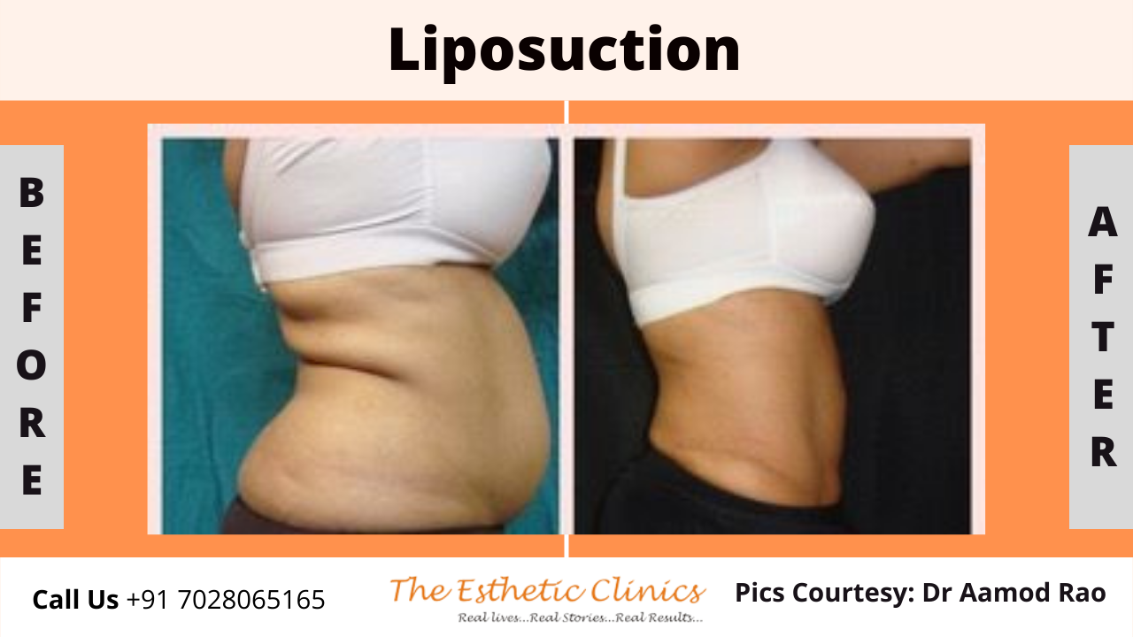 Best Body Contouring Surgery Treatment before after photos in Mumbai, India
