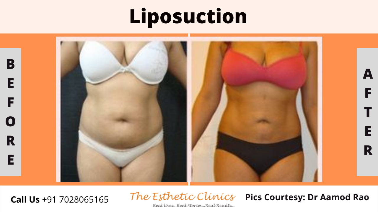 Best Body Contouring Surgery Treatment before after photos in Mumbai, India