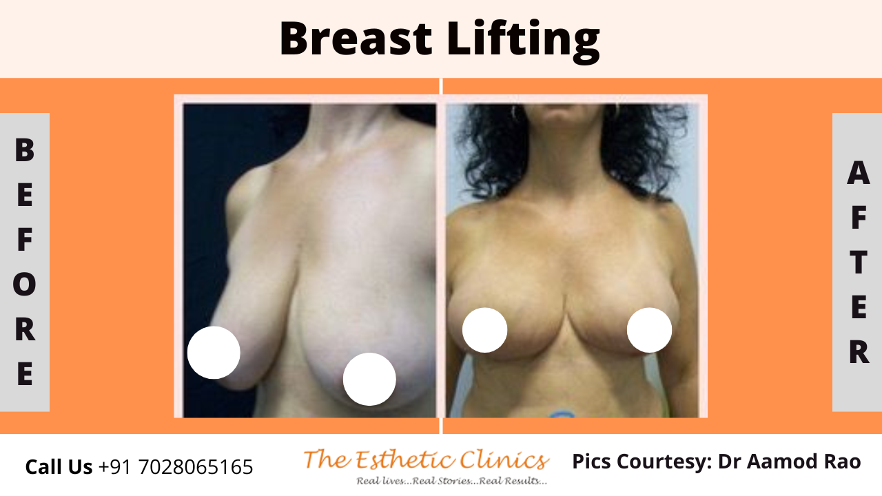 Best Body Contouring Surgery Treatment before after photos in Mumbai, India
