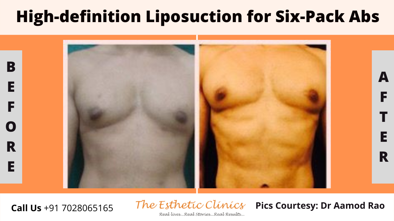 Best Body Contouring Surgery Treatment before after photos in Mumbai, India
