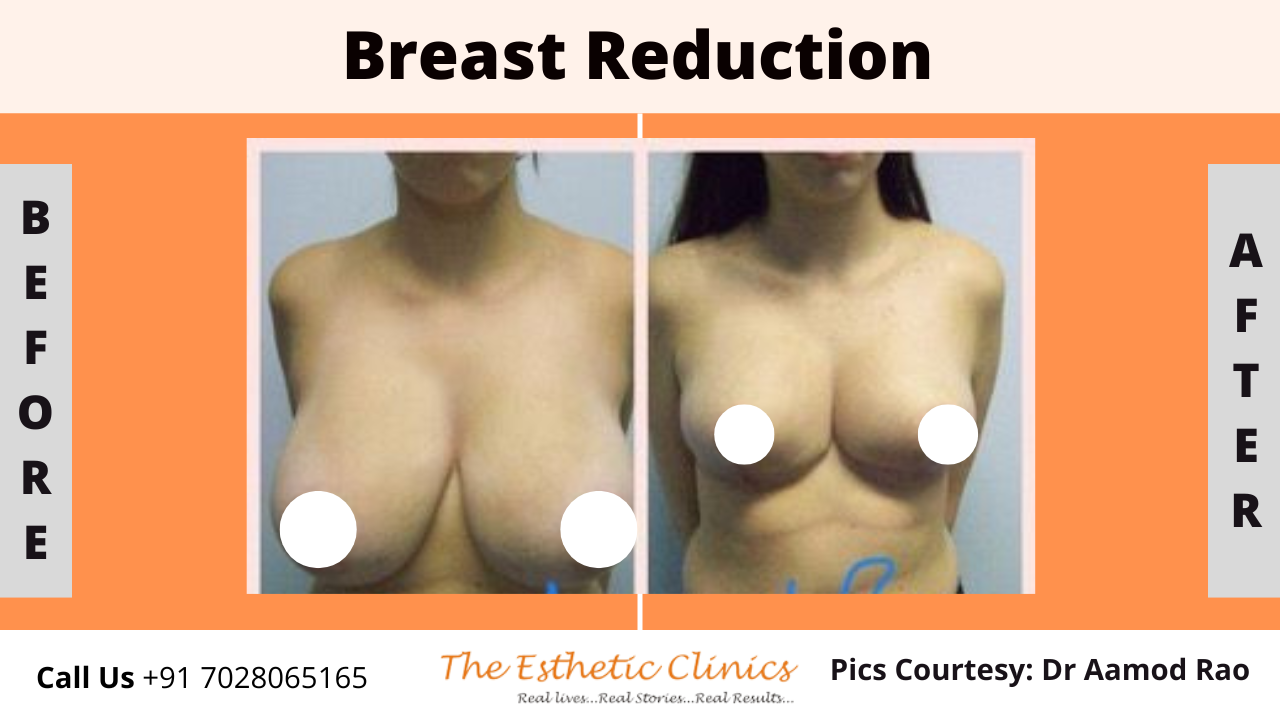 Best Body Contouring Surgery Treatment before after photos in Mumbai, India